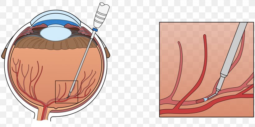 Central Retinal Vein Occlusion Vascular Occlusion, PNG, 1500x750px, Watercolor, Cartoon, Flower, Frame, Heart Download Free
