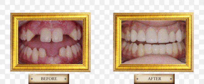 Tooth Picture Frames Health Tongue Beauty.m, PNG, 868x360px, Watercolor, Cartoon, Flower, Frame, Heart Download Free