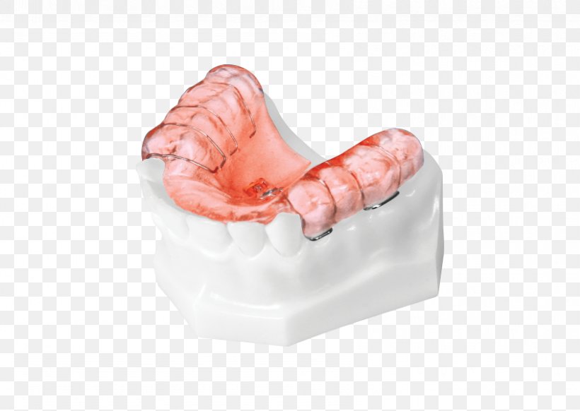 Tooth Orthodontics Home Appliance Orthodontic Technology Product Design, PNG, 845x600px, Tooth, Canine Tooth, Competition, Crossbite, Finger Download Free