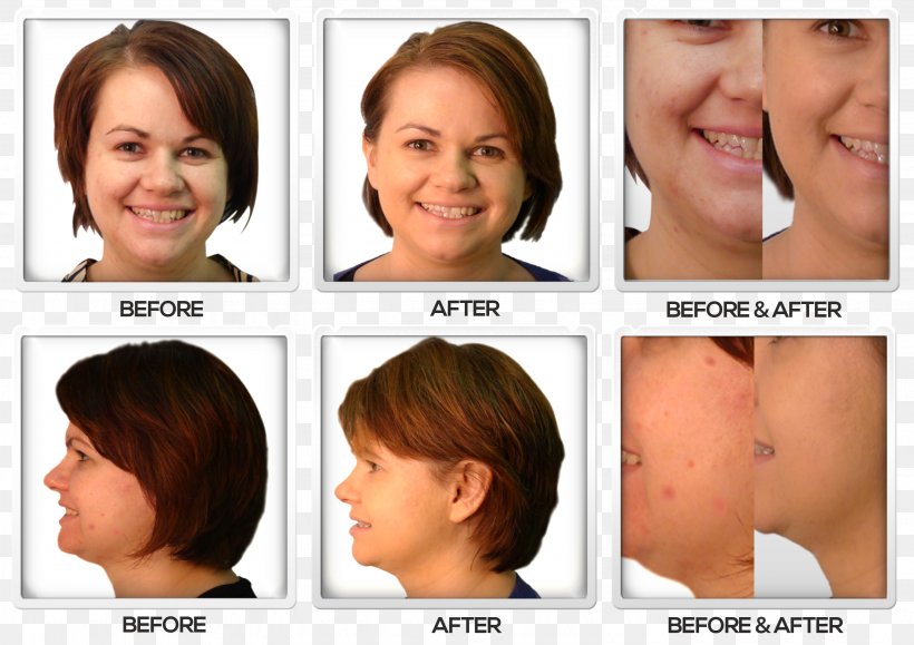 Cheek Nose Acne Lost 118 Chin, PNG, 3086x2180px, Cheek, Acne, Chin, Ear, Eyebrow Download Free