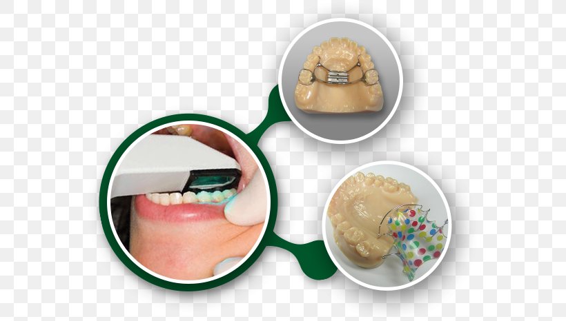 Retainer Orthodontics Laboratory Dental Braces Orthodontic Technology, PNG, 569x466px, Retainer, Basic Fit Nv, Business, Dental Braces, Dental Laboratory Download Free