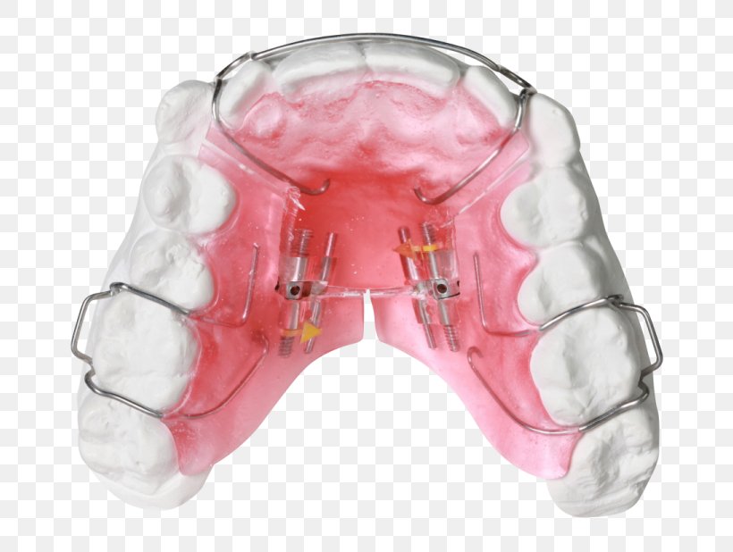 Orthodontics Dental Braces Dentist Retainer Tooth, PNG, 768x618px, Orthodontics, Clear Aligners, Dental Braces, Dentist, Dentistry Download Free