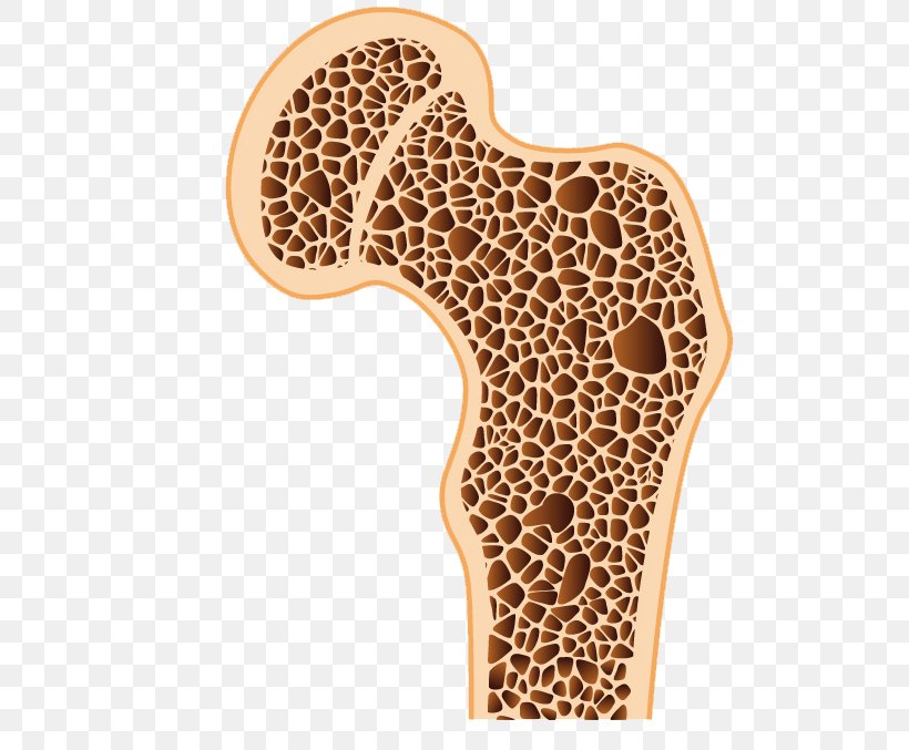Osteoporosis Bone Density Osteopenia Bone Disease, PNG, 524x677px, Osteoporosis, Bone, Bone Cyst, Bone Density, Bone Disease Download Free
