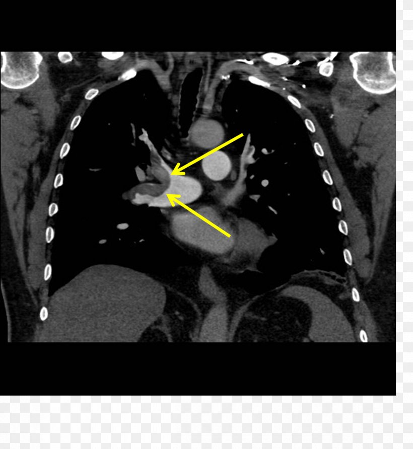 Pulmonary Artery Pulmonary Embolism Embolus CT Pulmonary Angiogram Lung, PNG, 1212x1319px, Watercolor, Cartoon, Flower, Frame, Heart Download Free