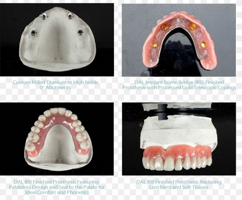 Tooth Dental Implant Bridge Prosthesis Dentures, PNG, 930x767px, Tooth, Bone, Bridge, Dental Implant, Dental Laboratory Download Free