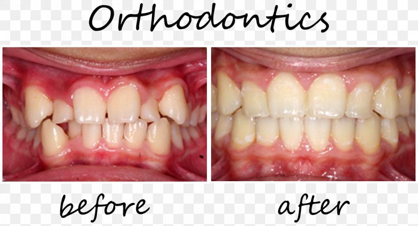Tooth Orthodontics Cosmetic Dentistry Dental Braces, PNG, 1200x651px, Tooth, Cosmetic Dentistry, Crown, Dental Braces, Dental Degree Download Free