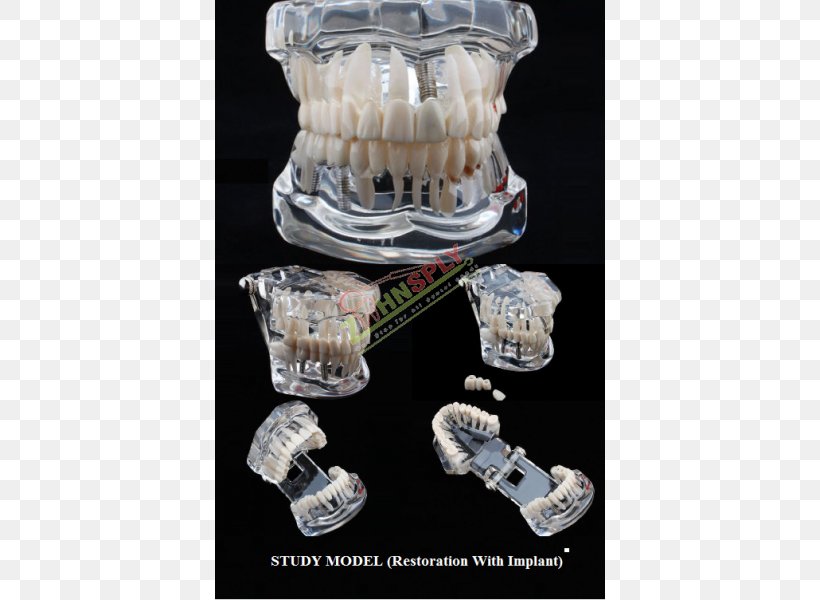 Tooth Decay Jaw Dentistry Bridge, PNG, 600x600px, Tooth, Bridge, Dental Implant, Dentistry, Education Download Free