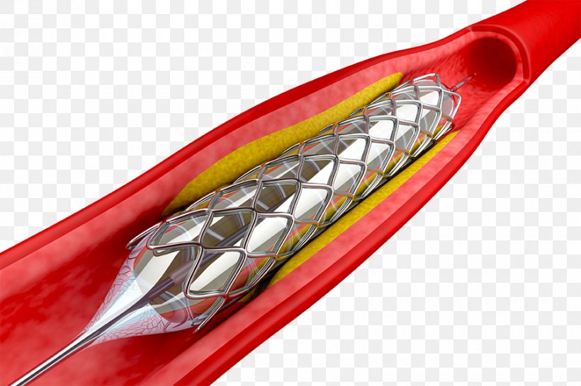 Angioplasty Percutaneous Coronary Intervention Stenting Coronary Stent Balloon Catheter, PNG, 900x600px, Angioplasty, Artery, Atheroma, Balloon Catheter, Blood Vessel Download Free