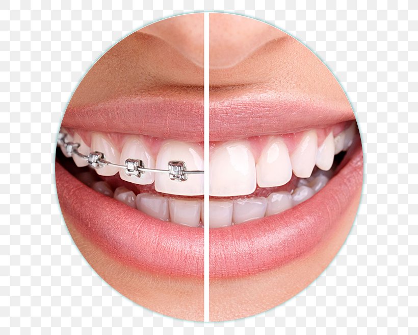 Dentistry Orthodontics Dental Braces Clear Aligners, PNG, 656x656px, Dentistry, Chin, Clear Aligners, Cosmetic Dentistry, Dental Braces Download Free