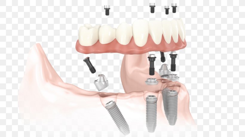 All-on-4 Dental Implant Dentistry Dentures, PNG, 720x460px, Dental Implant, Bridge, Cosmetic Dentistry, Dental Surgery, Dentist Download Free