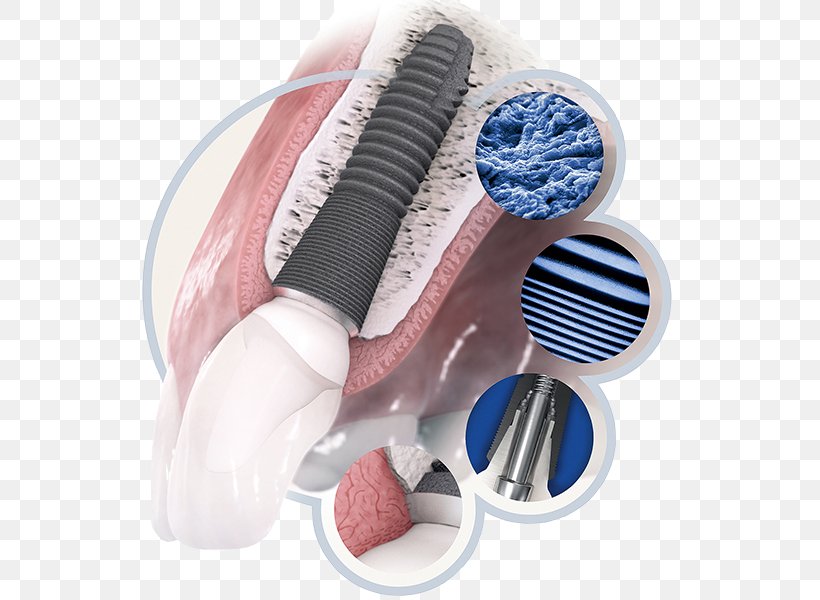Dental Implant Dentistry Tooth, PNG, 537x600px, Dental Implant, Bone, Brush, Dental Hygienist, Dentist Download Free