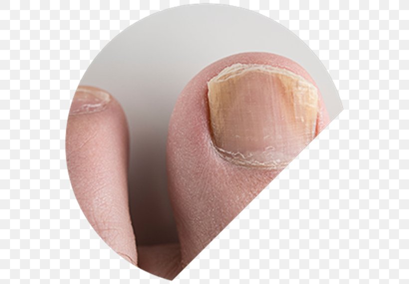 Onychomycosis The Nail Fungal Nail Infection, PNG, 570x570px, Watercolor, Cartoon, Flower, Frame, Heart Download Free