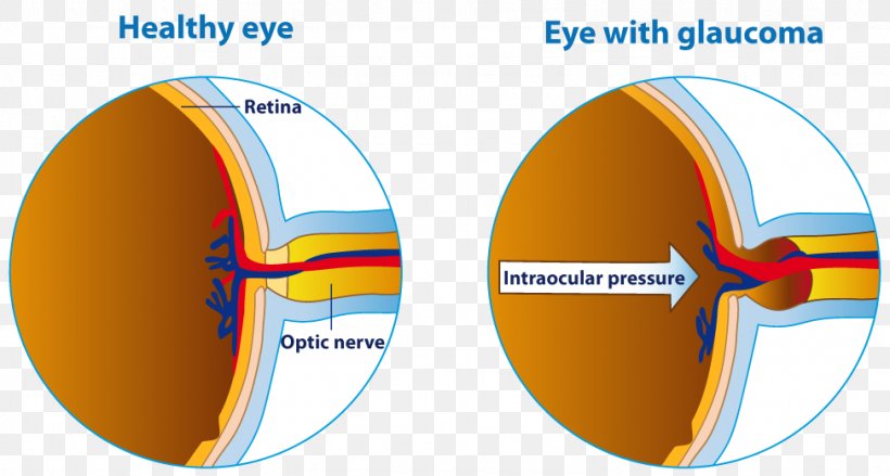 Human Eye Glaucoma Eye Care Professional Optic Nerve, PNG, 973x522px, Human Eye, Blindness, Diagram, Eye, Eye Care Professional Download Free