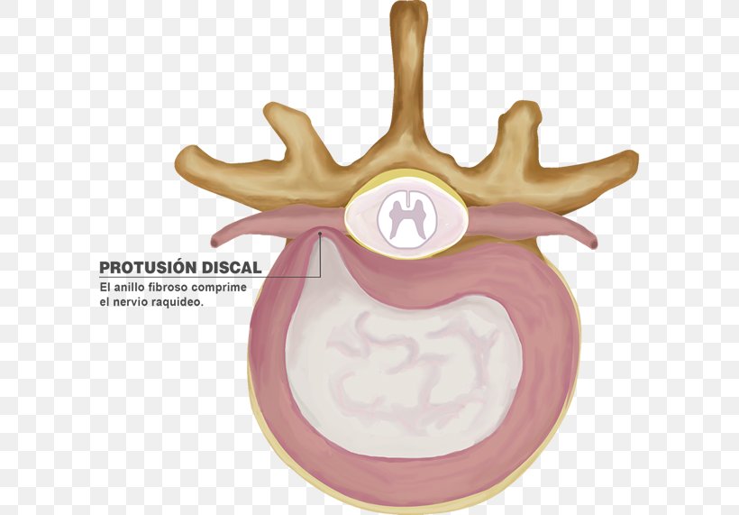 Intervertebral Disc Spinal Disc Herniation Lumbar Vertebrae Disc Protrusion, PNG, 600x571px, Watercolor, Cartoon, Flower, Frame, Heart Download Free