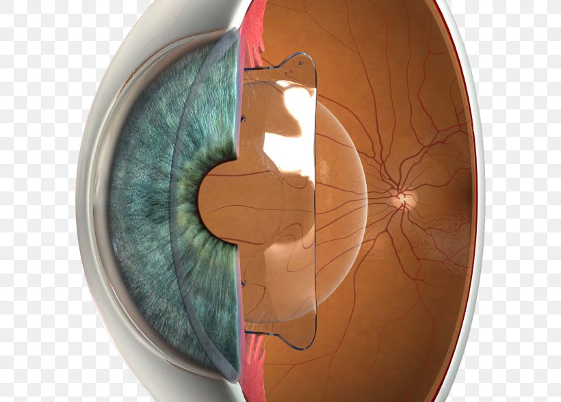 Phakic Intraocular Lens Implantable Collamer Lens LASIK Visual Perception, PNG, 600x588px, Watercolor, Cartoon, Flower, Frame, Heart Download Free