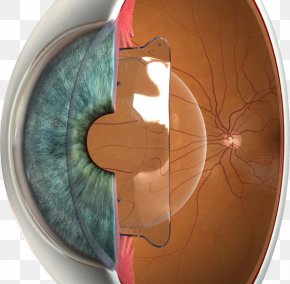 Eye - Phakic Intraocular Lens Implantable Collamer Lens LASIK Visual Perception PNG
