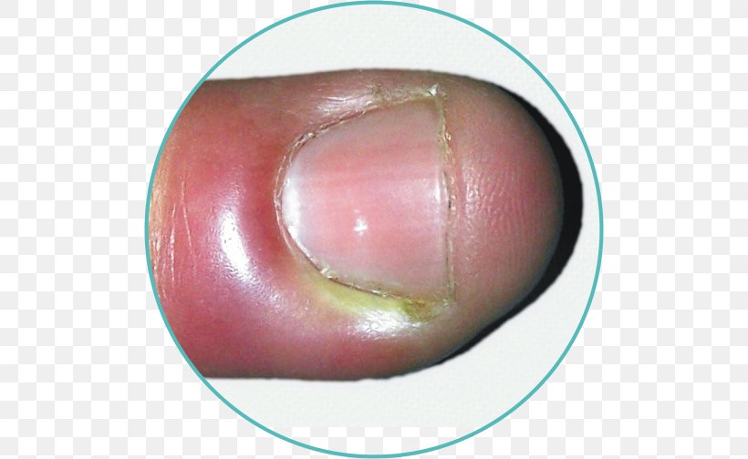 Nail Paronychia Inflammation Folliculitis Infection, PNG, 504x504px, Nail, Acne, Bacteria, Body, Body Hair Download Free