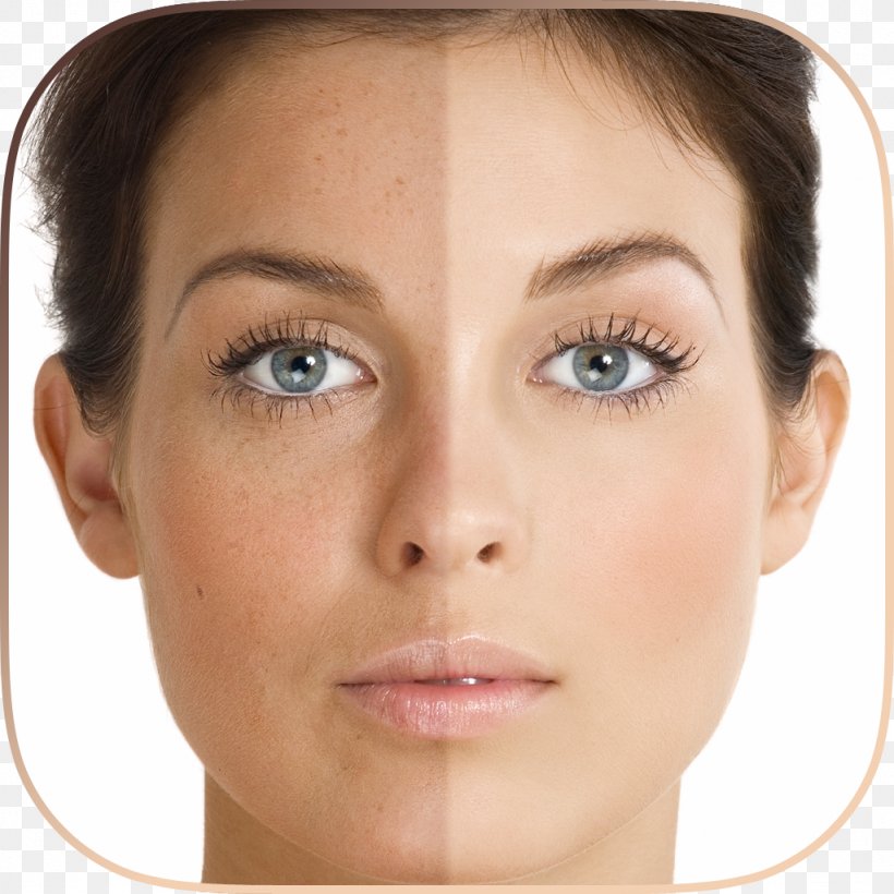 Hyperpigmentation Skin Care Liver Spot Pimple, PNG, 1024x1024px, Hyperpigmentation, Acne, Antiaging Cream, Beauty, Botulinum Toxin Download Free