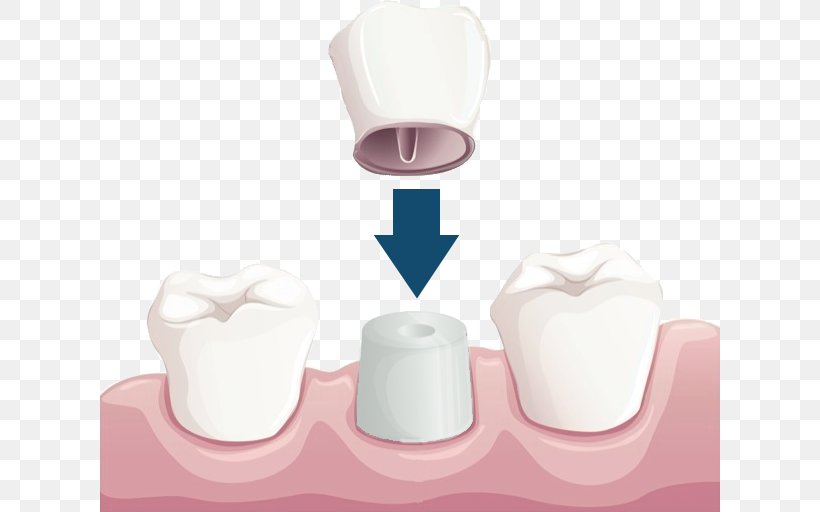 Crown Dentistry Dental Restoration Bridge, PNG, 620x512px, Crown, Bridge, Cadcam Dentistry, Cosmetic Dentistry, Dental Implant Download Free