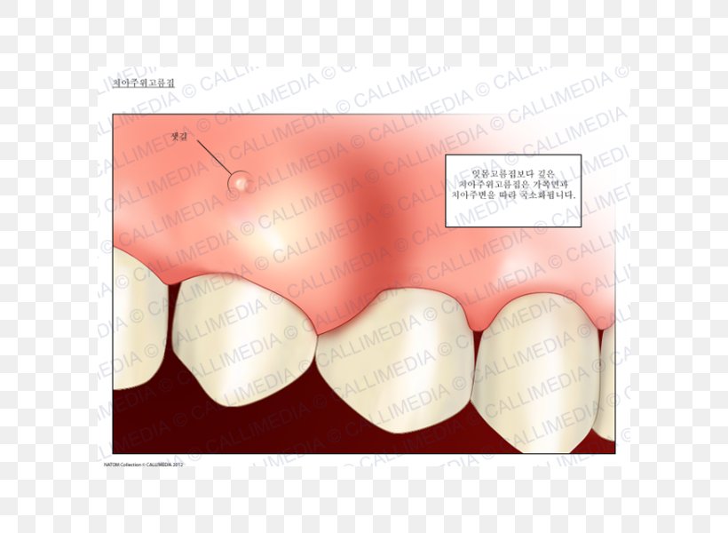 Dental Abscess Periodontal Abscess Gums Tooth, PNG, 600x600px, Watercolor,  Cartoon, Flower, Frame, Heart Download Free