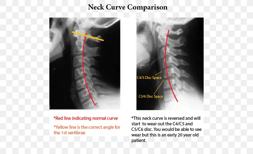 Neck Pain Whiplash Cervical Vertebrae X-ray, PNG, 500x500px, Neck Pain, Cervical Vertebrae, Chiropractic, Headache, Health Care Download Free