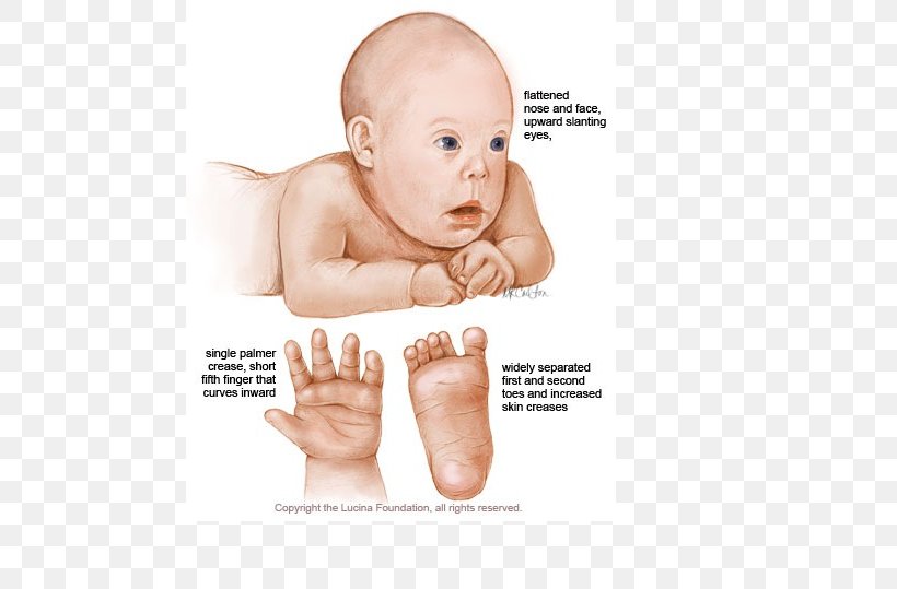 Trisomy Down Syndrome Chromosome 21 Chromosome Abnormality, PNG, 480x539px, Watercolor, Cartoon, Flower, Frame, Heart Download Free