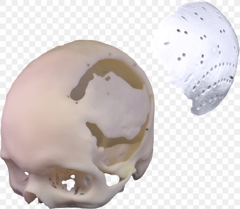 3D Printing Poly Xilloc Implant Plastic, PNG, 1074x935px, 3d Printing, Biomaterial, Bone, Implant, Innovation Download Free