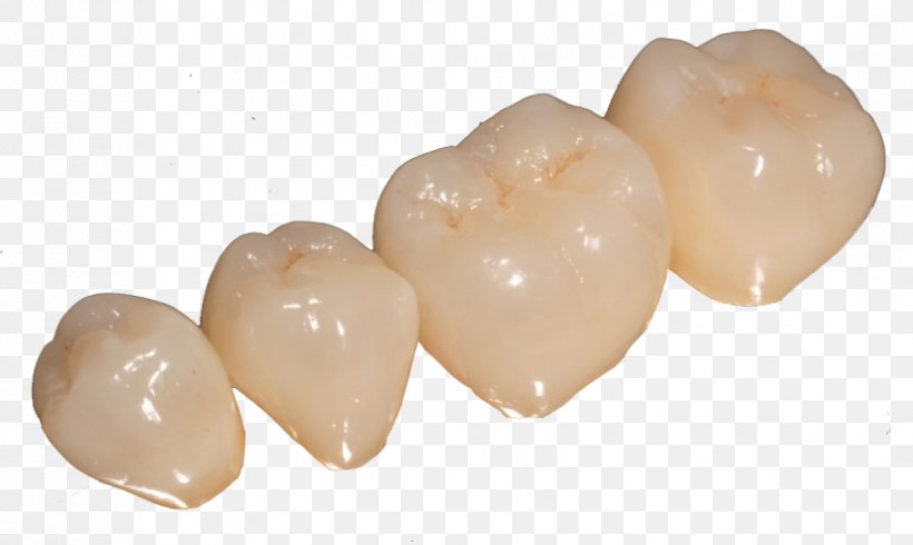 Dentures Prótesis Fija Tooth Crown Dentist, PNG, 826x494px, Dentures, Ceramic, Crown, Dentist, Laboratory Download Free