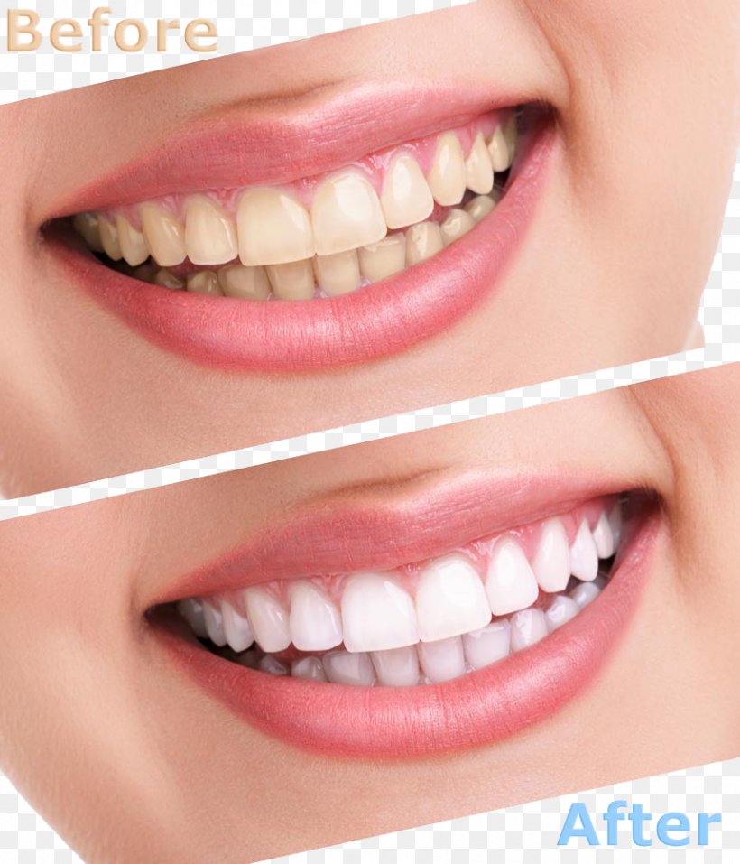 Tooth Whitening Human Tooth Cosmetic Dentistry, PNG, 856x1000px, Tooth Whitening, Cheek, Chin, Close Up, Cosmetic Dentistry Download Free