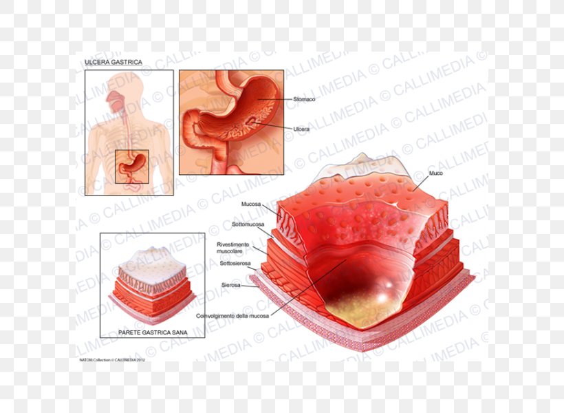 Skin Ulcer Peptic Ulcer Disease Gastric Erosion Gastritis, PNG, 600x600px, Watercolor, Cartoon, Flower, Frame, Heart Download Free