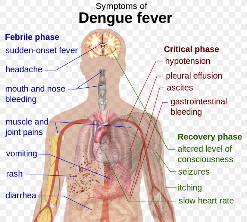 Mosquito Dengue Fever Scarlet Fever Disease Complication, PNG, 850x768px, Watercolor, Cartoon, Flower, Frame, Heart Download Free