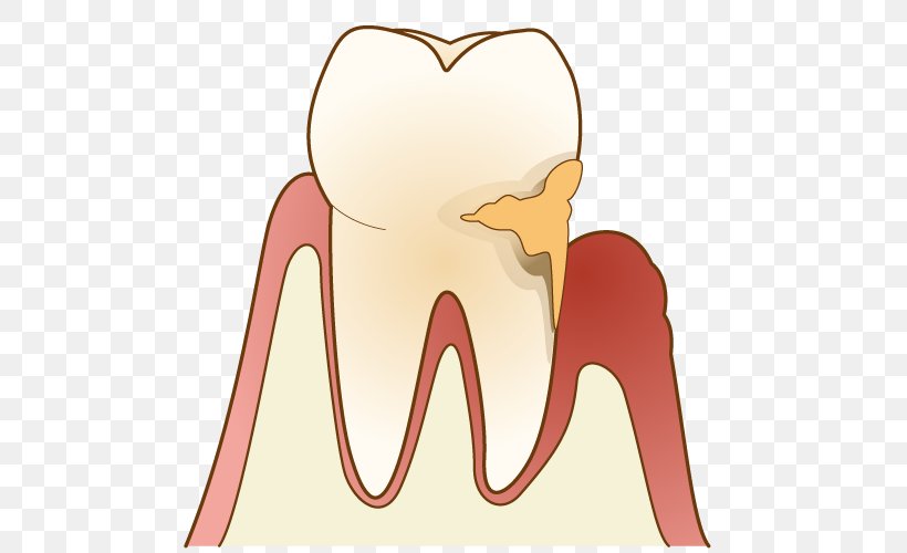 Periodontal Disease Gums 歯科 Dentist Dental Plaque, PNG, 500x500px, Watercolor, Cartoon, Flower, Frame, Heart Download Free