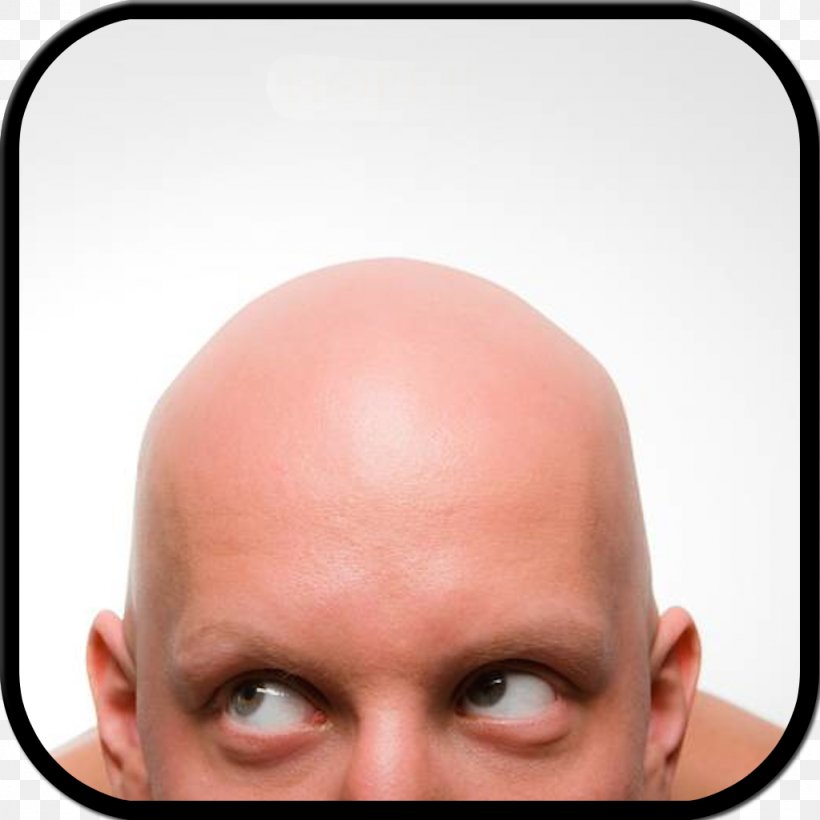 Hair Loss Hair Transplantation Follicular Unit Extraction Skinhead, PNG, 1024x1024px, Hair Loss, Botak, Buzz Cut, Capelli, Cheek Download Free