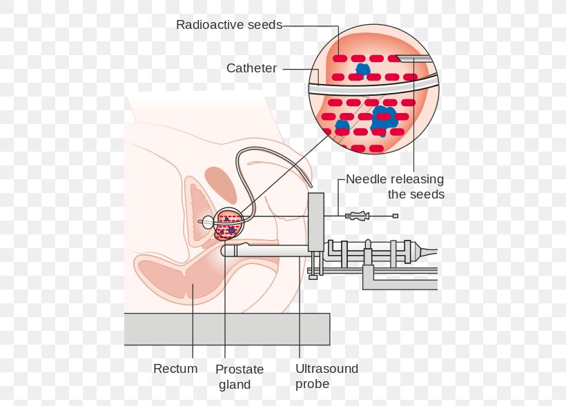 Radiation Therapy Brachytherapy Prostate Cancer Proton Therapy Treatment Of Cancer, PNG, 500x589px, Watercolor, Cartoon, Flower, Frame, Heart Download Free