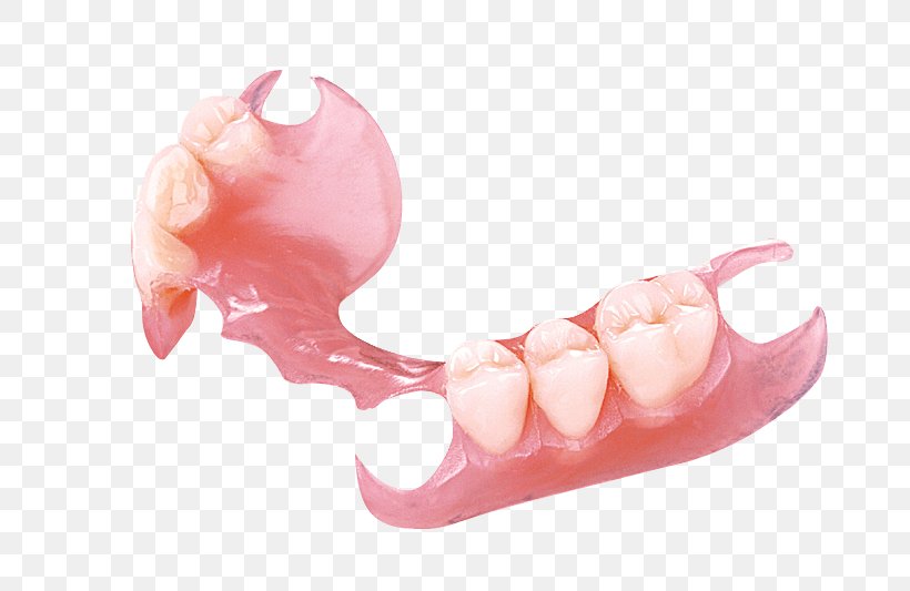 Removable Partial Denture Dentures Dentistry Crown, PNG, 800x533px, Removable Partial Denture, Bridge, Cadcam Dentistry, Crown, Dental Arch Download Free