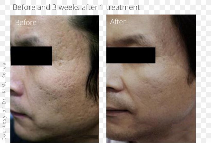 Scar Acne Cheek Surgery Wrinkle, PNG, 1024x697px, Scar, Acne, Adverse Effect, Cheek, Chin Download Free