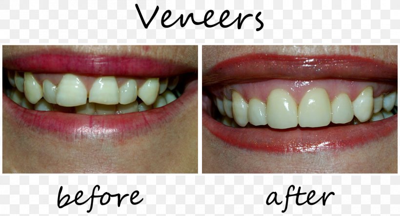Tooth Veneer Dentistry Patient, PNG, 1200x651px, Tooth, Cosmetic Dentistry, Dental Degree, Dental Implant, Dental Surgery Download Free
