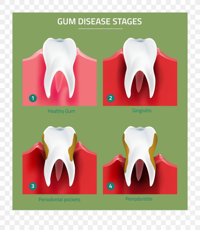 Tooth Gums Periodontal Disease Gingivitis Periodontology, PNG, 2406x2759px, Tooth, Bone, Dentist, Dentistry, Disease Download Free