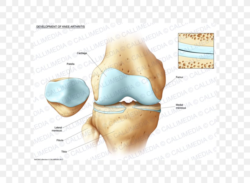 Knee Bone Fracture Tibia Pathology, PNG, 600x600px, Watercolor, Cartoon, Flower, Frame, Heart Download Free
