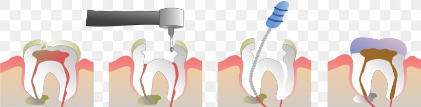 Endodontic Therapy Root Canal Endodontics Pulp Dentist, PNG, 1170x300px, Endodontic Therapy, Brush, Crown, Cutlery, Dental Abscess Download Free