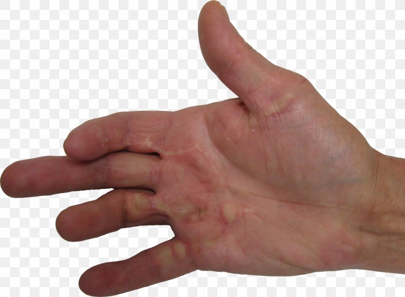 Dupuytren's Contracture Thumb Plantar Fibromatosis Disease Health, PNG, 2461x1802px, Thumb, Arm, Contracture, Disease, Finger Download Free