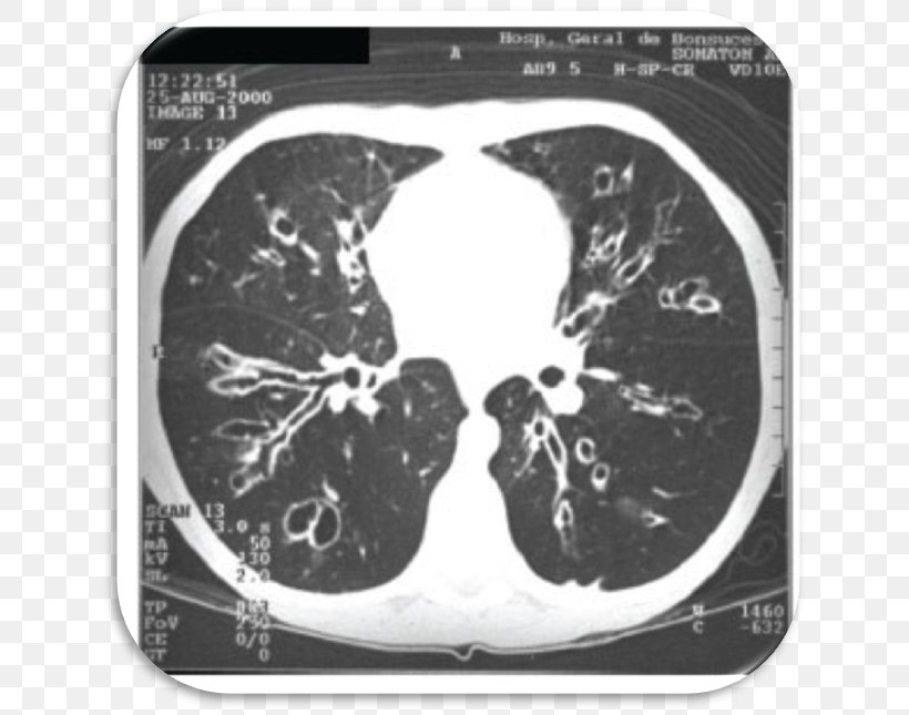Computed Tomography Radiology Cystic Fibrosis Bronchiectasis, PNG, 645x645px, Watercolor, Cartoon, Flower, Frame, Heart Download Free