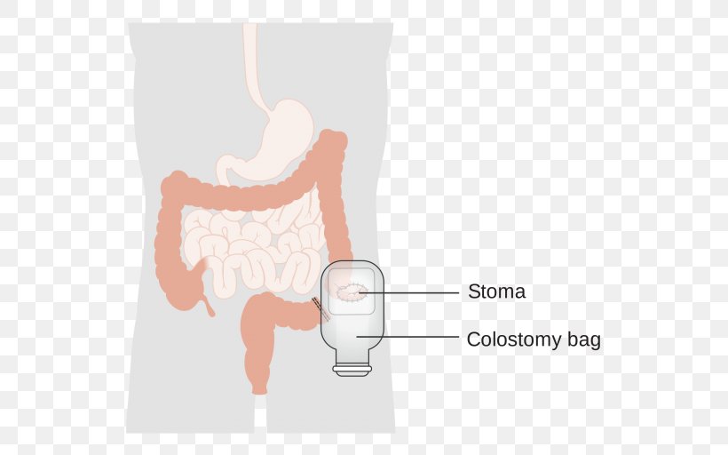 Colostomy Stoma Ileostomy Surgery Ostomy Pouching System, PNG, 600x512px, Watercolor, Cartoon, Flower, Frame, Heart Download Free