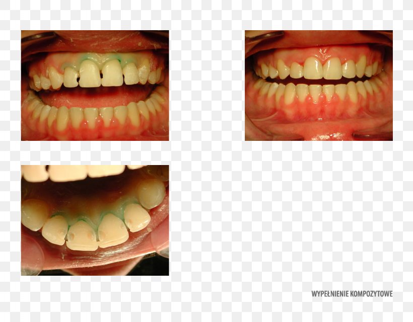 Tooth Decay Dentistry Orthodontics Orange, PNG, 1024x800px, Tooth, Clinic, Close Up, Composite Material, Cosmetic Dentistry Download Free