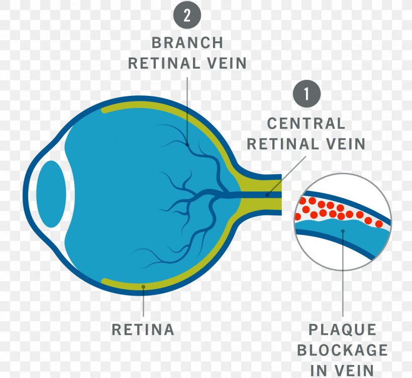 Flash Blindness Central Retinal Vein Occlusion Eye Logo, PNG, 1360x1250px, Blindness, Aqua, Central Retinal Vein Occlusion, Diagram, Disease Download Free