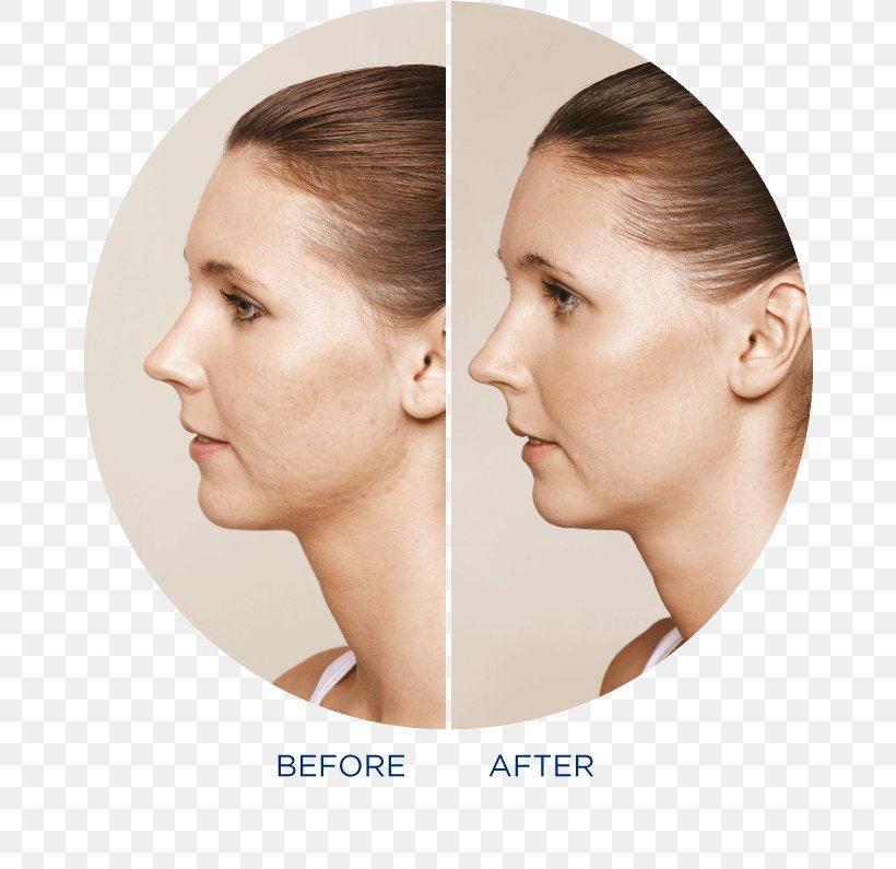 Collagen Induction Therapy Restylane Wrinkle, PNG, 668x795px, Collagen Induction Therapy, Aesthetic Medicine, Antiaging Cream, Beauty, Cheek Download Free