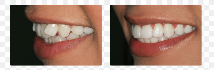 Tooth Cosmetic Dentistry ORDINACIJA DENTALNE MEDICINE JASNA CUPEC, PNG, 1074x353px, Tooth, Cheek, Chin, Cosmetic Dentistry, Crossbite Download Free