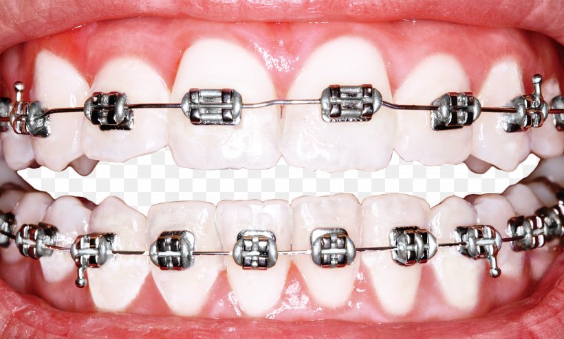 Dental Braces Dentistry Orthodontics Tooth Whitening, PNG, 2048x1236px, Dental Braces, Clear Aligners, Cosmetic Dentistry, Damon System, Dental Extraction Download Free