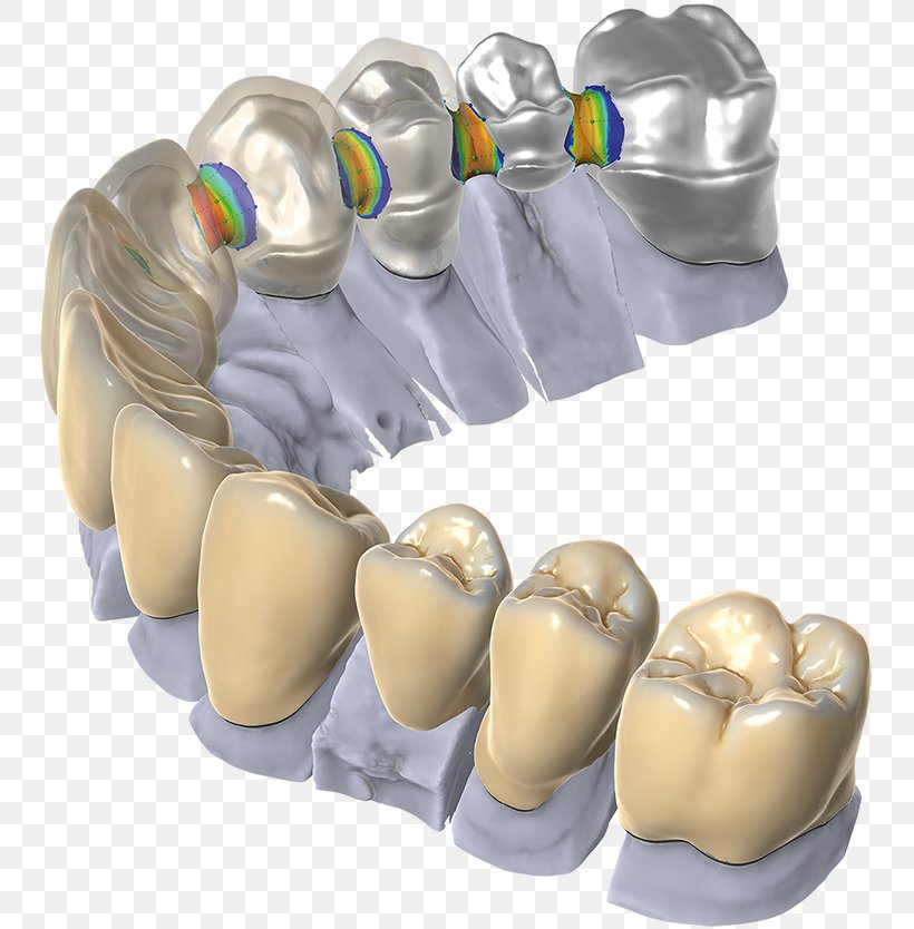 CAD/CAM Dentistry Computer-aided Design Dental Restoration Computer Software, PNG, 750x834px, 3d Scanner, Cadcam Dentistry, Cadstar, Computer Software, Computeraided Design Download Free