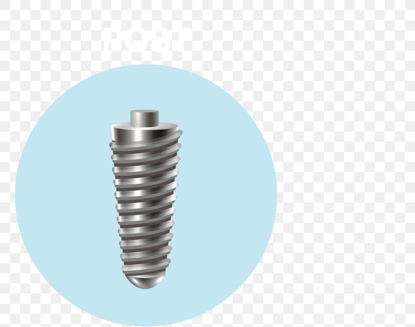 Dental Implant Dentistry Tooth Dental Surgery, PNG, 761x646px, Dental Implant, Child, Dental Surgery, Dentistry, Fastener Download Free